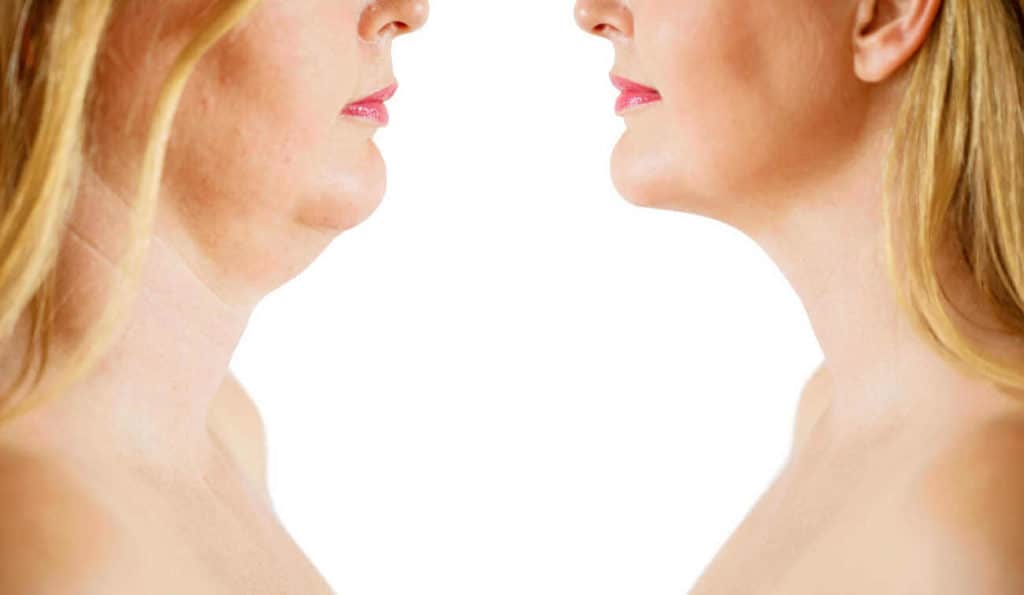 Double Chin treatment Cheltenham before and after results