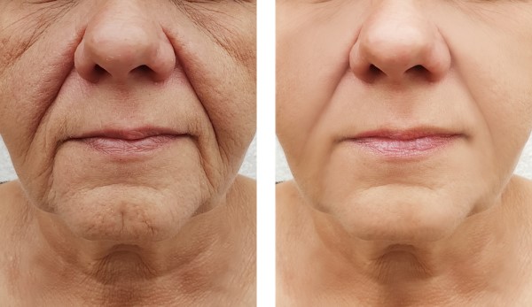 Learn more about Morpheus8 Treatment Cheltenham today!