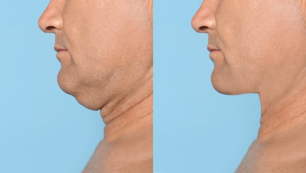 Which Non-Surgical Treatments Work Best for Jowls and Loose Skin Cheltenham?
