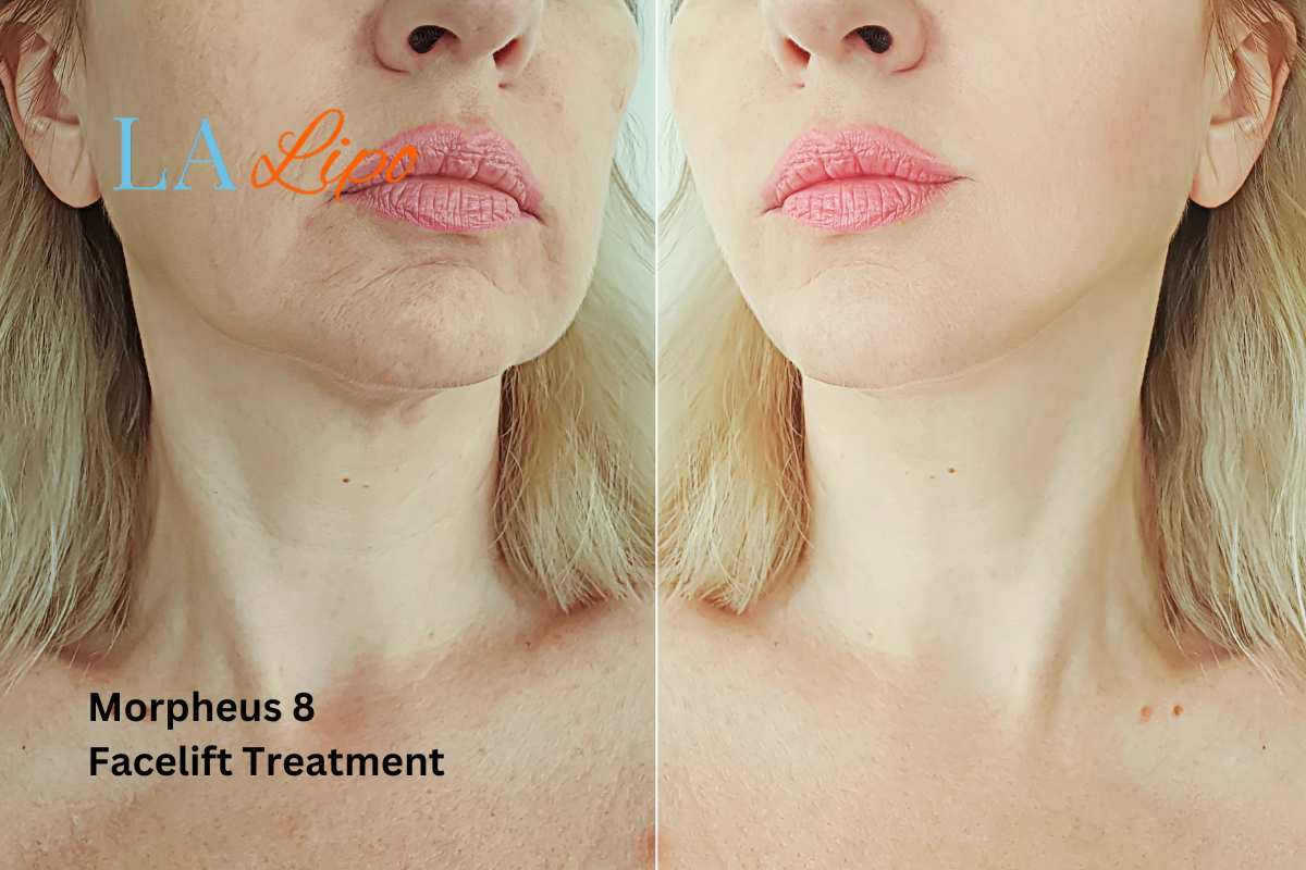 Turn back time with Morpheus8 Treatment Cheltenham
