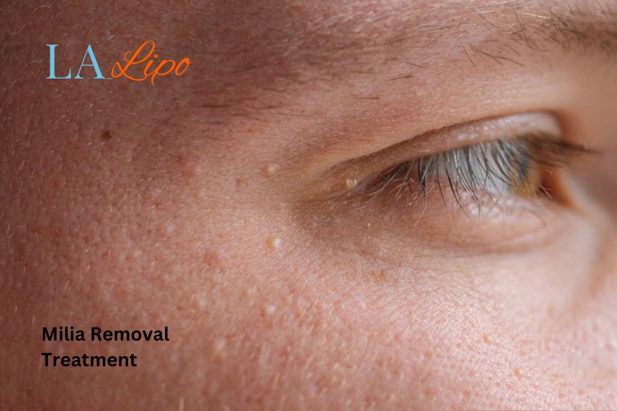 Cryopen Milia Removal: Is It the Easiest and Safest Option Cheltenham?