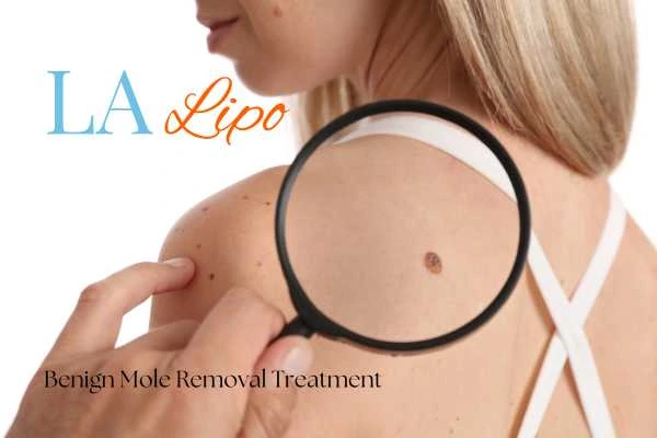 Why getting moles removed Cheltenham can boost your confidence!