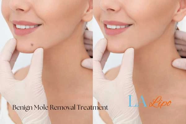 woman's before and after mole removal Cheltenham results