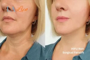 hi-fu for wrinkles Cheltenham before and after results