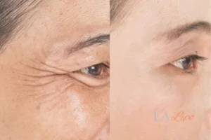 Before and after results of woman - HI-fu wrinkles reduction treatment Cheltenham