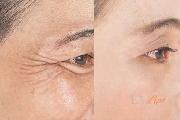 Before and after results of woman - HI-fu wrinkles reduction treatment Cheltenham