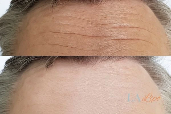 results of HIFU Cheltenham on mans forehead to help reduce lines and wrinkles