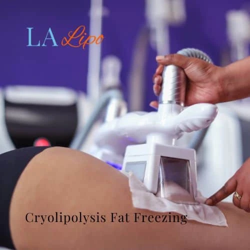 fat freezing - Cryolipolysis Cheltenham