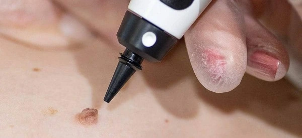 skin tag removal using cryopen Cheltenham