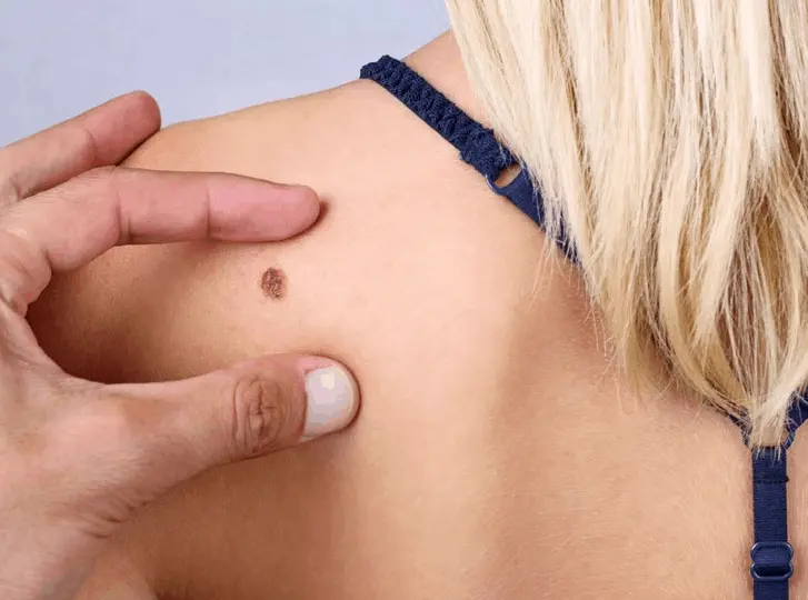 woman having mole removal Cheltenham consultation before treatment.