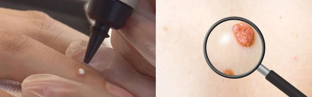 Person getting moles removed with cryopen Cheltenham