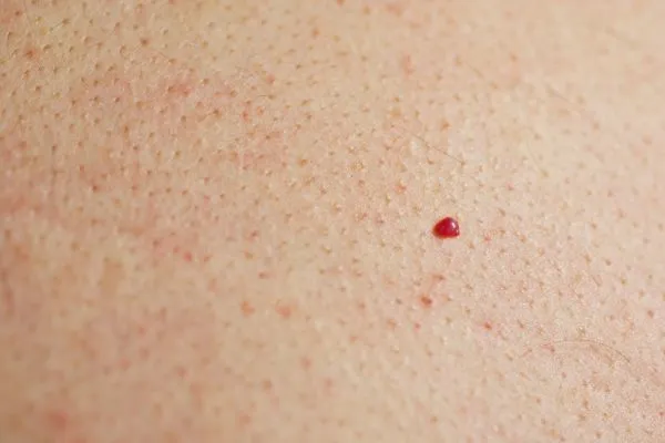 close up of a cherry angioma Cheltenham