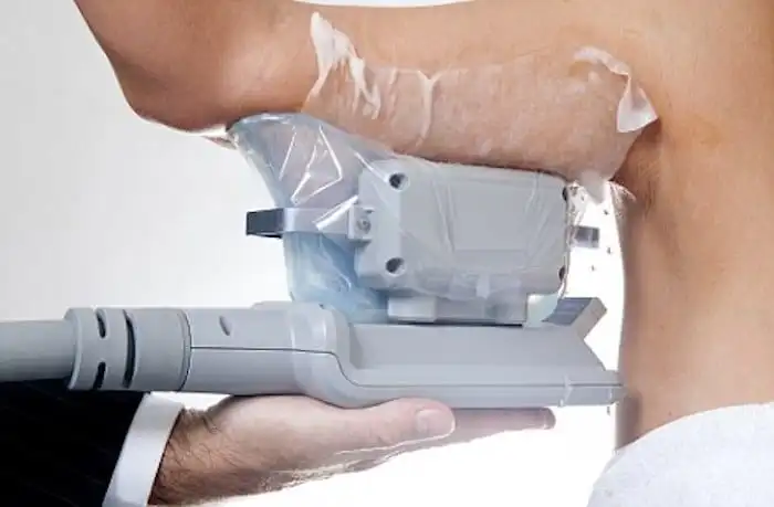 Picture of fat freezing Cheltenham on the upper arms.