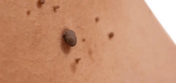 image of a skin tag Cheltenham