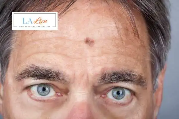 Solar Lentigo Removal Cheltenham image of man with mark on his forehead