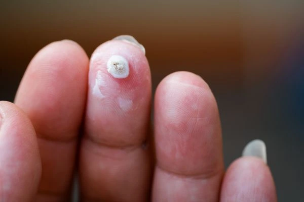 wart on person finger - cryotherapy to treat from LA LIPO Cheltenham