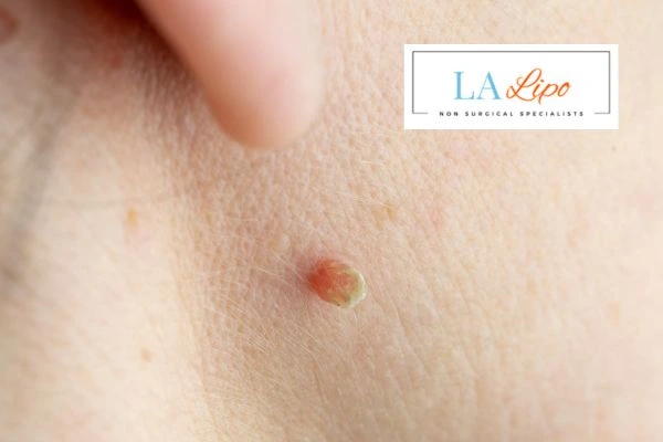 Book skin tag removal Cheltenham today speak to our team now!