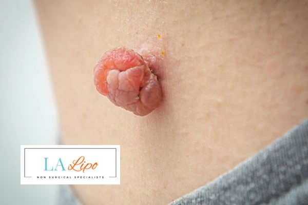 Interested in skin tag removal Cheltenham? Concerned about the pain? Find out more today!