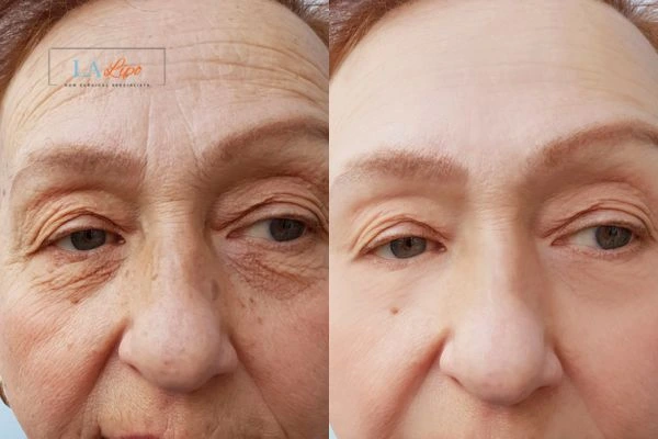 The powerful benefits of Morpheus8 Treatment Cheltenham - Call Our team today!