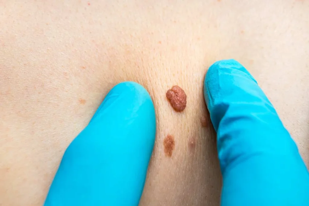 LA LIPO Cryopen Lesion Removal Prices Cheltenham