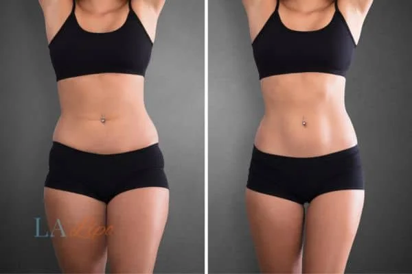 before and after results of non-surgical treatment to help a woman's body image and mental health Cheltenham