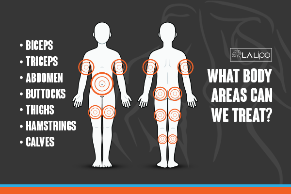 Diagram to show areas you can have LA-EMS Body Sculpting Treatment Cheltenham