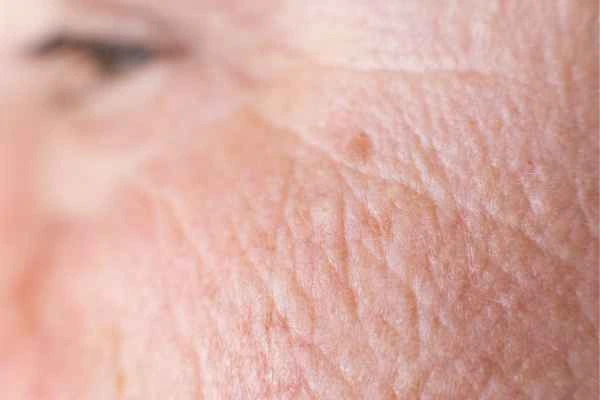 close up picture of a woman's face showing an age spot Cheltenham