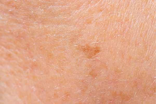 close up picture of age spots Cheltenham