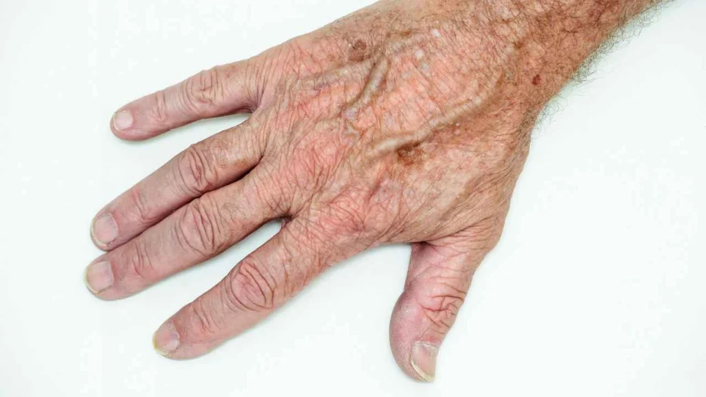 Male hand showing age spot Cheltenham