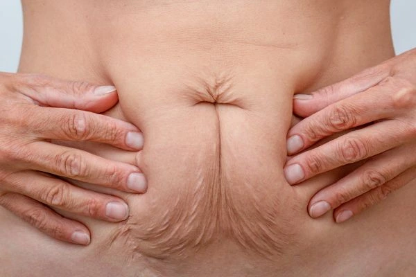 Image of a woman's stomach with loose skin - example of skin tightening Cheltenham options