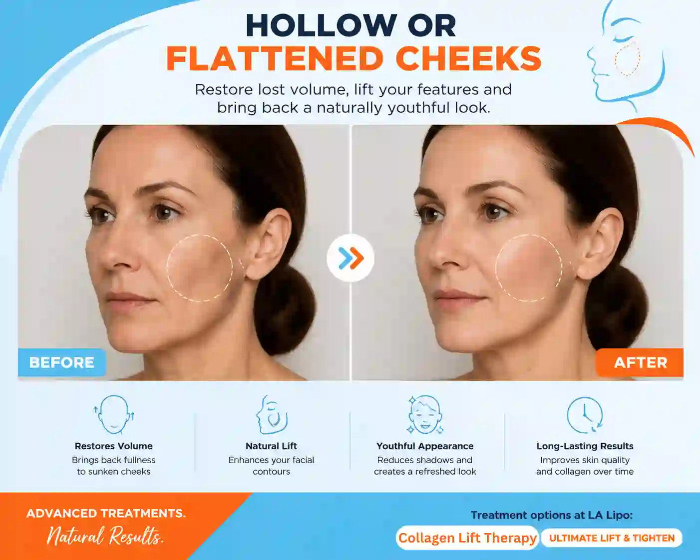 Sign #4: Hollow or Flattened Cheeks Cheltenham